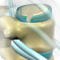 chiropractic_slipped_disc